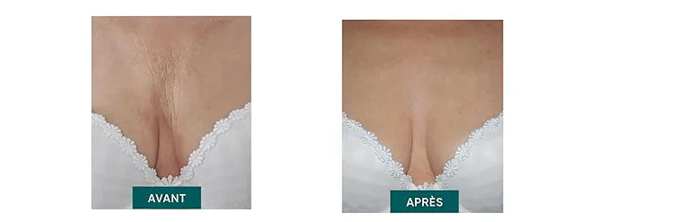 Photo avant après patchs en silicone nocturnes
