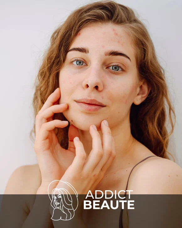 Portrait rapproché d'une belle femme sans maquillage à la peau imparfaite. Peau acnéique. Beauté naturelle