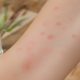 découvrez des méthodes efficaces pour apaiser les démangeaisons causées par les piqûres de poux et soulager rapidement l'inconfort.