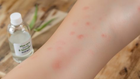 découvrez des méthodes efficaces pour apaiser les démangeaisons causées par les piqûres de poux et soulager rapidement l'inconfort.