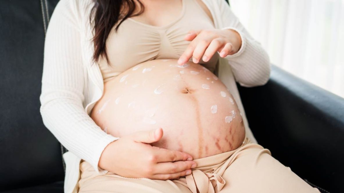 Femme enceinte appliquant de la crème sur son ventre pour prévenir les vergetures