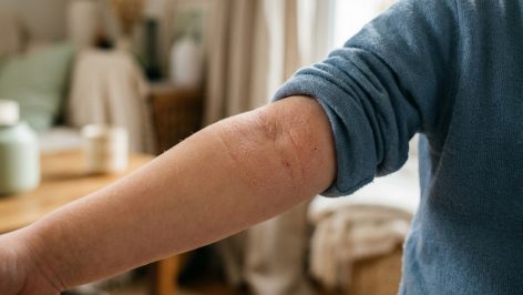 peau-qui-gratte-chez-l-enfant-comprendre-l-eczema-featured